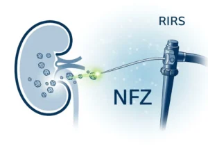 Ilustracja medyczna RIRS na NFZ: nerka z kamieniami leczona endoskopem.